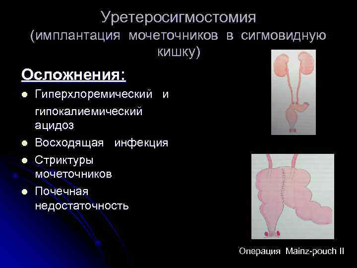 Уретеросигмостомия (имплантация мочеточников в сигмовидную кишку) Осложнения: l l Гиперхлоремический и гипокалиемический ацидоз Восходящая