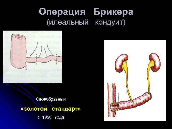 Операция Брикера (илеальный кондуит) Своеобразный «золотой стандарт» с 1950 года 