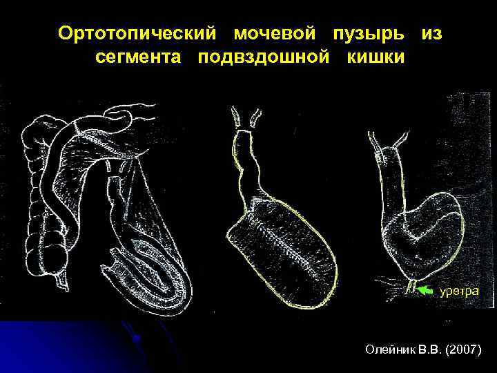Ортотопический мочевой пузырь из сегмента подвздошной кишки уретра Олейник В. В. (2007) 