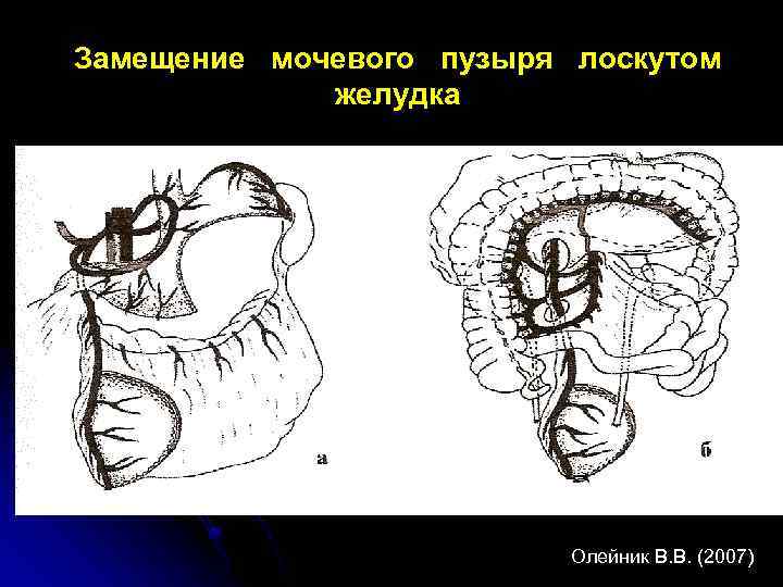 Замещение мочевого пузыря лоскутом желудка Олейник В. В. (2007) 