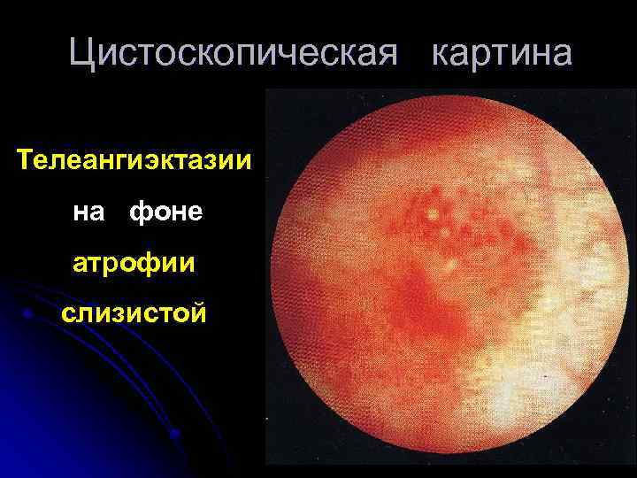 Цистоскопическая картина Телеангиэктазии на фоне атрофии слизистой 
