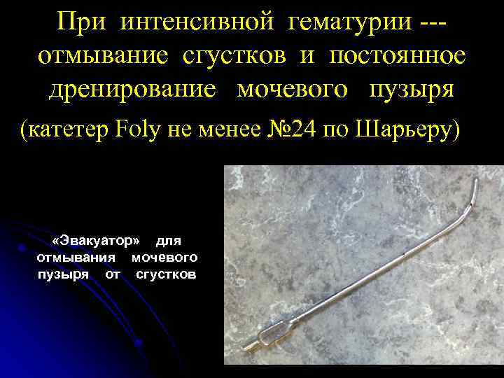При интенсивной гематурии --отмывание сгустков и постоянное дренирование мочевого пузыря (катетер Foly не менее