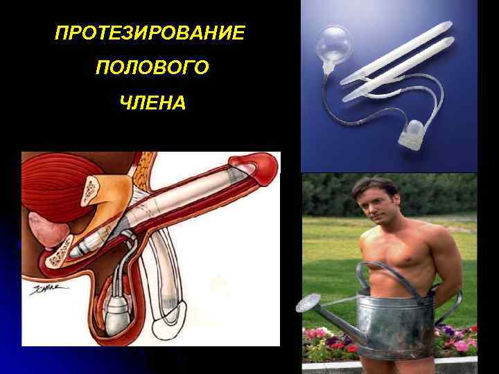 ПРОТЕЗИРОВАНИЕ ПОЛОВОГО ЧЛЕНА 