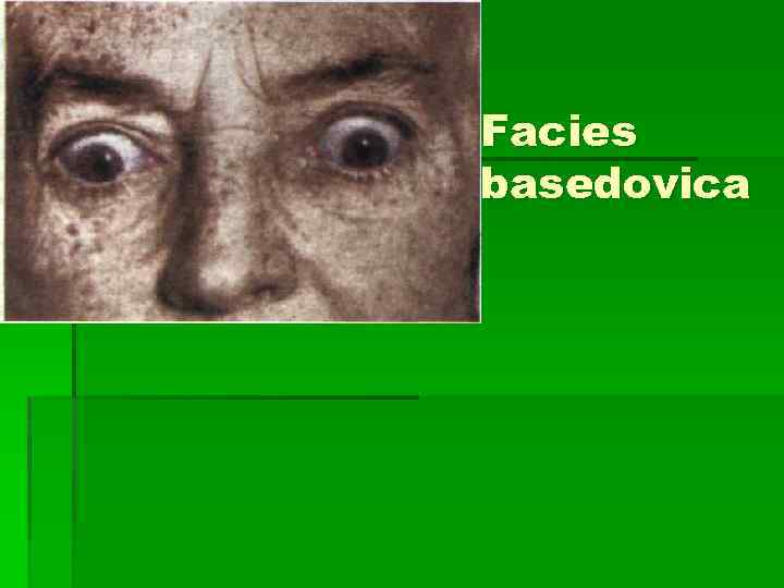 Facies basedovica 