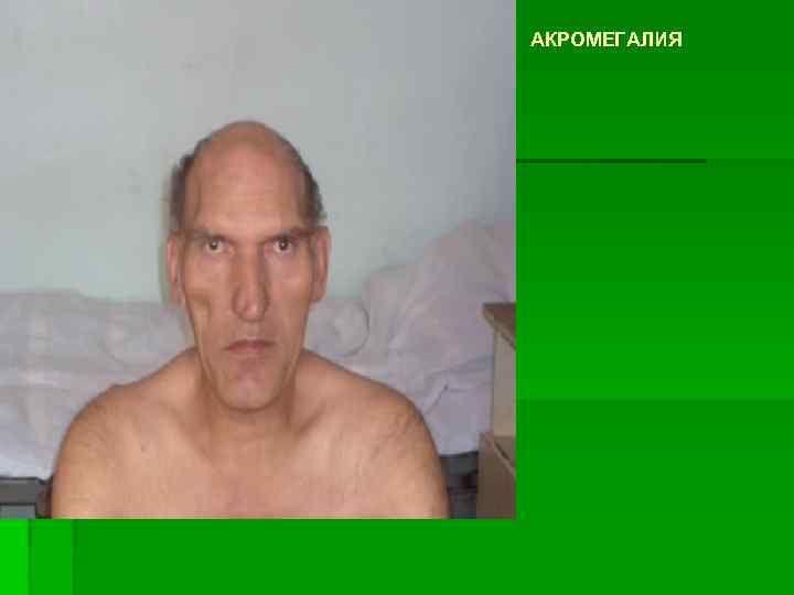 АКРОМЕГАЛИЯ 