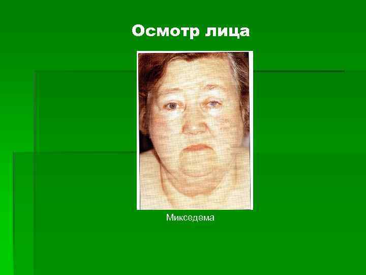 Микседема симптомы фото