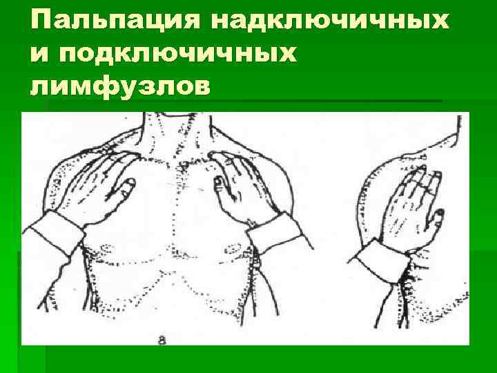 Пальпация надключичных и подключичных лимфузлов 