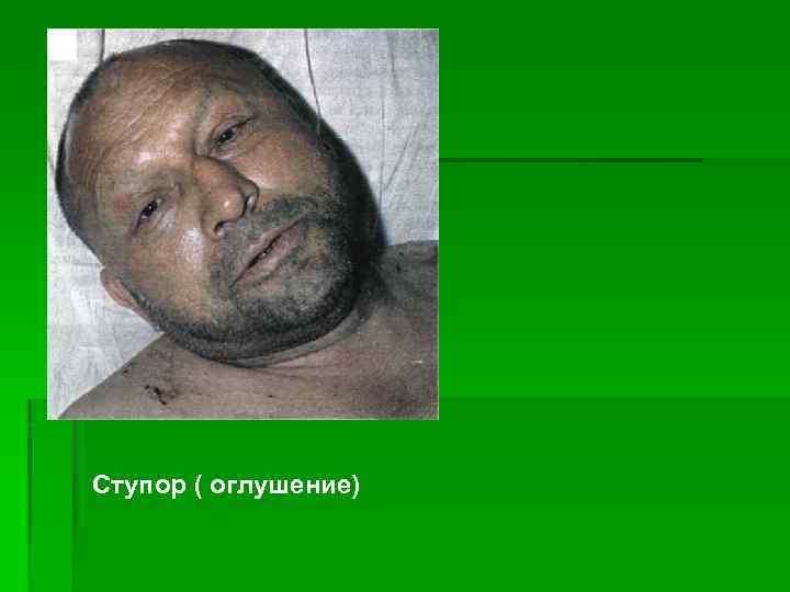 Ступор ( оглушение) 