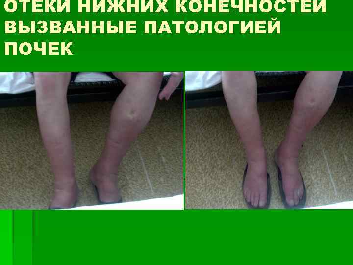 ОТЁКИ НИЖНИХ КОНЕЧНОСТЕЙ ВЫЗВАННЫЕ ПАТОЛОГИЕЙ ПОЧЕК 