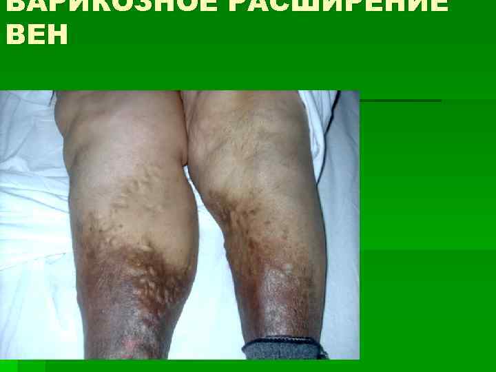 ВАРИКОЗНОЕ РАСШИРЕНИЕ ВЕН 