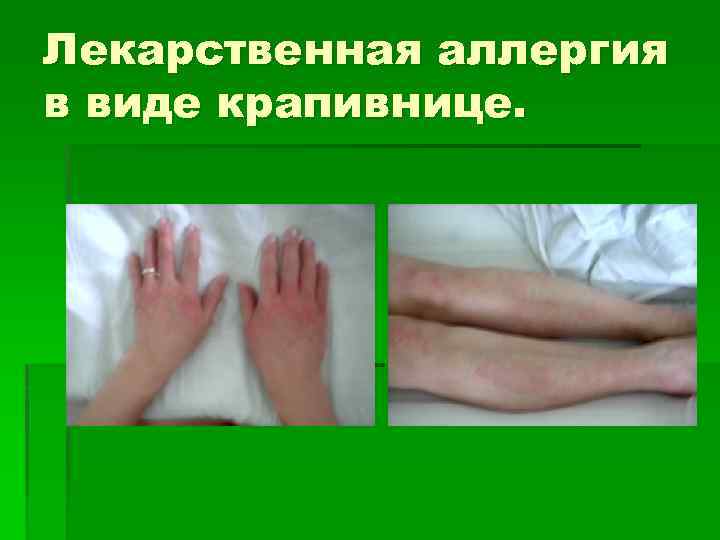 Лекарственная аллергия в виде крапивнице. 