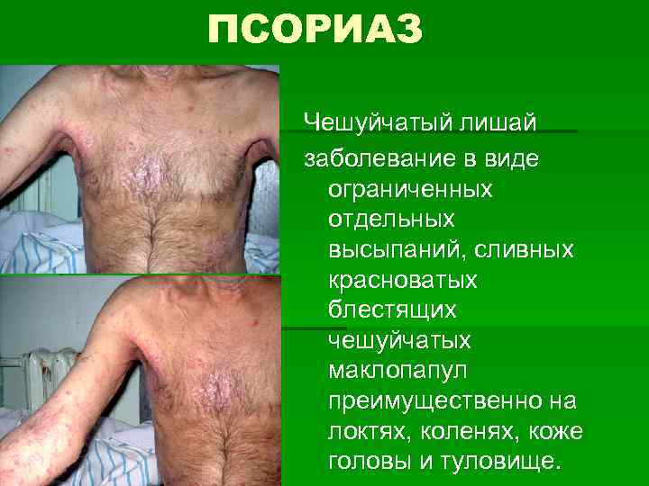 ПСОРИАЗ Чешуйчатый лишай заболевание в виде ограниченных отдельных высыпаний, сливных красноватых блестящих чешуйчатых маклопапул
