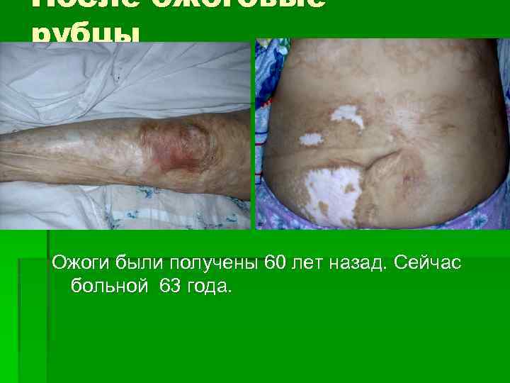 После ожоговые рубцы Ожоги были получены 60 лет назад. Сейчас больной 63 года. 