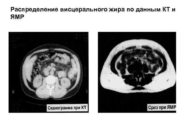 Распределение висцерального жира по данным КТ и ЯМР 