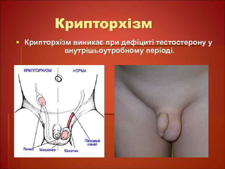 Крипторхізм § Крипторхізм виникає при дефіциті тестостерону у внутрішьоутробному періоді. 
