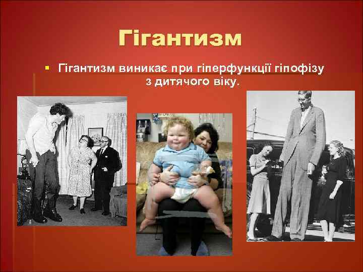 Гігантизм § Гігантизм виникає при гіперфункції гіпофізу з дитячого віку. 