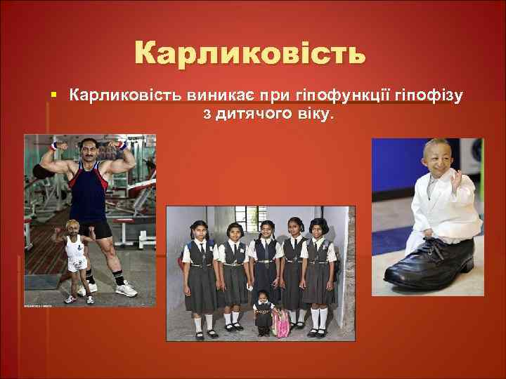 Карликовість § Карликовість виникає при гіпофункції гіпофізу з дитячого віку. 