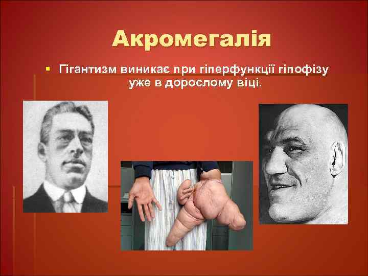 Акромегалія § Гігантизм виникає при гіперфункції гіпофізу уже в дорослому віці. 