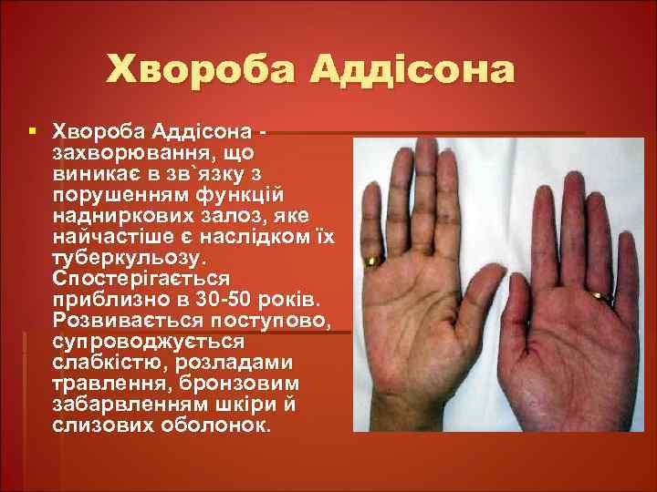 Хвороба Аддісона § Хвороба Аддісона захворювання, що виникає в зв`язку з порушенням функцій надниркових
