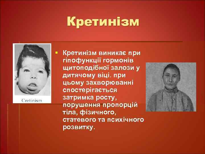 Кретинізм § Кретинізм виникає при гіпофункції гормонів щитоподібної залози у дитячому віці. при цьому