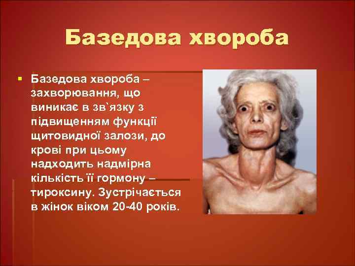 Базедова хвороба § Базедова хвороба – захворювання, що виникає в зв`язку з підвищенням функції