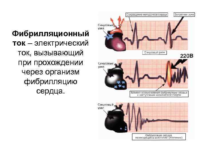 Фибрилляционный ток – электрический ток, вызывающий при прохождении через организм фибрилляцию сердца. 