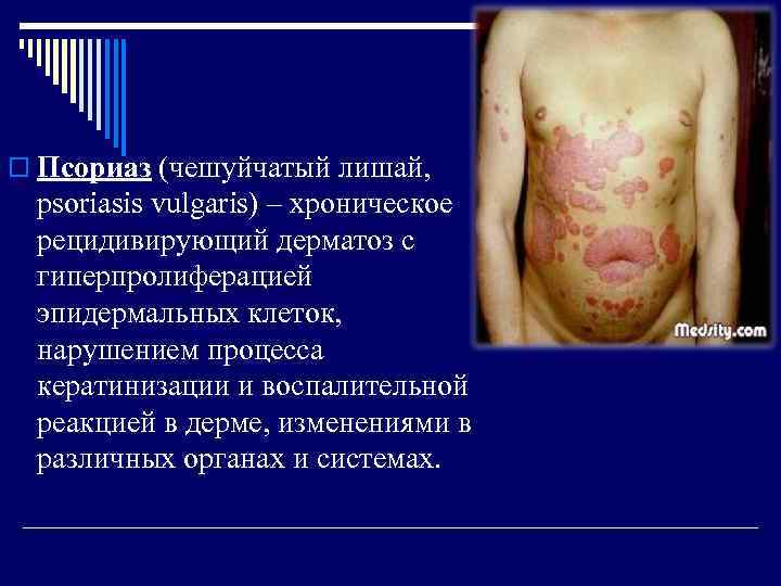o Псориаз (чешуйчатый лишай, psoriasis vulgaris) – хроническое рецидивирующий дерматоз с гиперпролиферацией эпидермальных клеток,