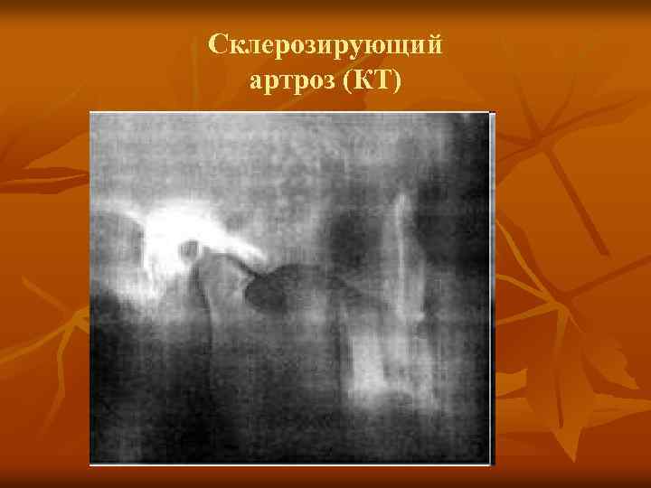 Склерозирующий артроз (КТ) 