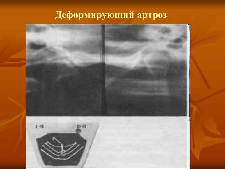 Деформирующий артроз 