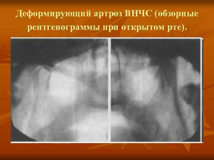 Рентгенологическая картина при хронических артритах височно нижнечелюстного сустава