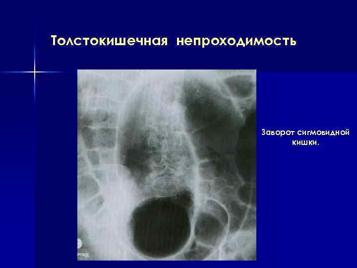 Толстокишечная непроходимость Заворот сигмовидной кишки. 