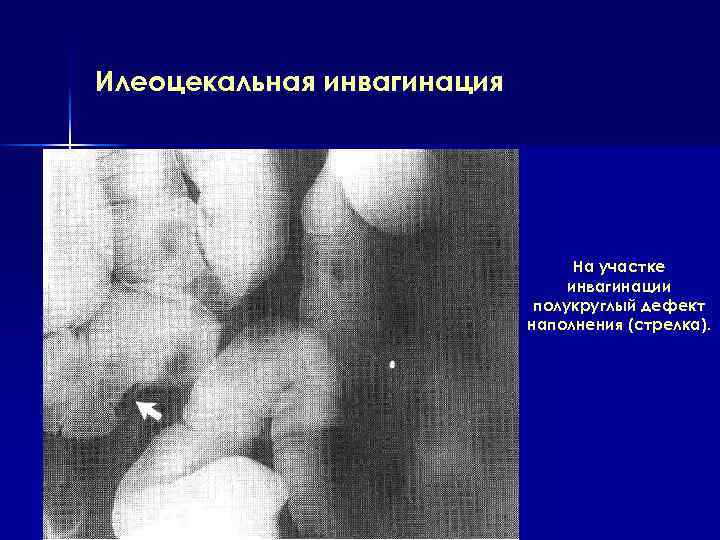 Илеоцекальная инвагинация На участке инвагинации полукруглый дефект наполнения (стрелка). 