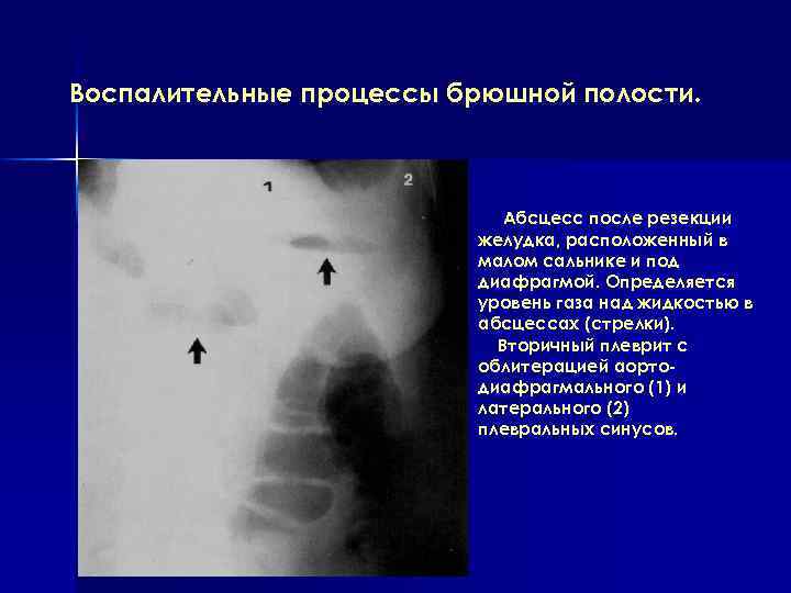Воспалительные процессы брюшной полости. Абсцесс после резекции желудка, расположенный в малом сальнике и под