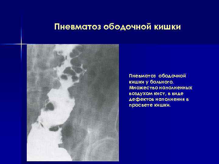 Пневматоз ободочной кишки у больного. Множество наполненных воздухом кист, в виде дефектов наполнения в