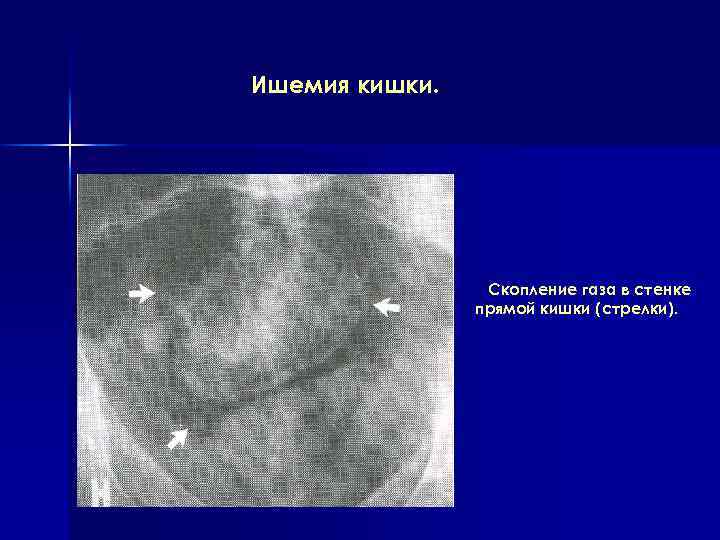 Ишемия кишки. Скопление газа в стенке прямой кишки (стрелки). 