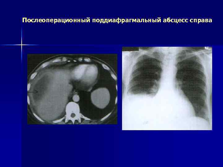 Послеоперационный поддиафрагмальный абсцесс справа 