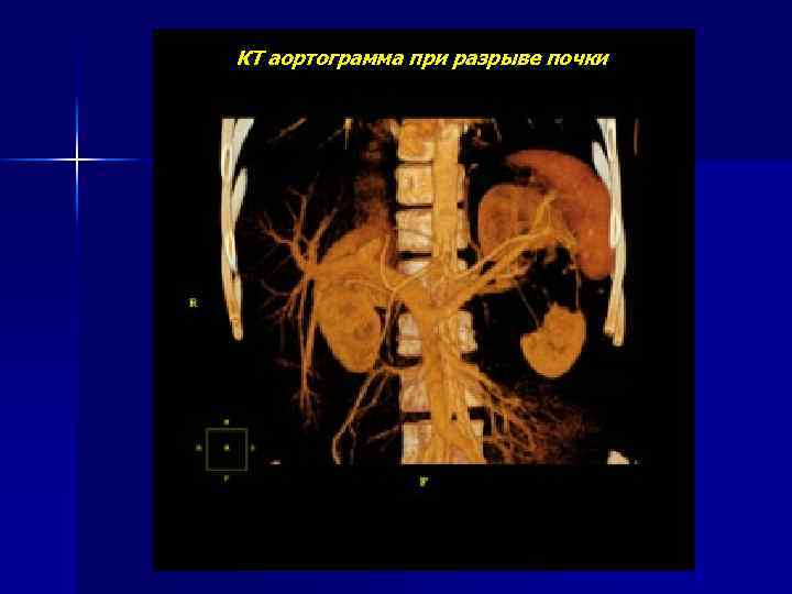 КТ аортограмма при разрыве почки 