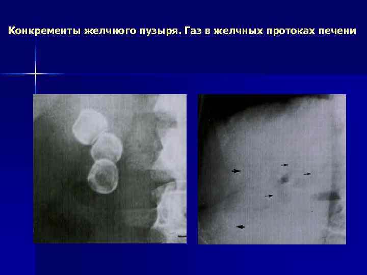 Конкременты желчного пузыря. Газ в желчных протоках печени 