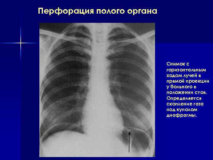 Перфорация полого органа. Перфорация полых органов брюшной полости. Рентгенологическая картина перфорация полого органа. Перфорация язвы рентген признаки. Рентгенологические симптомы перфорации полого органа.