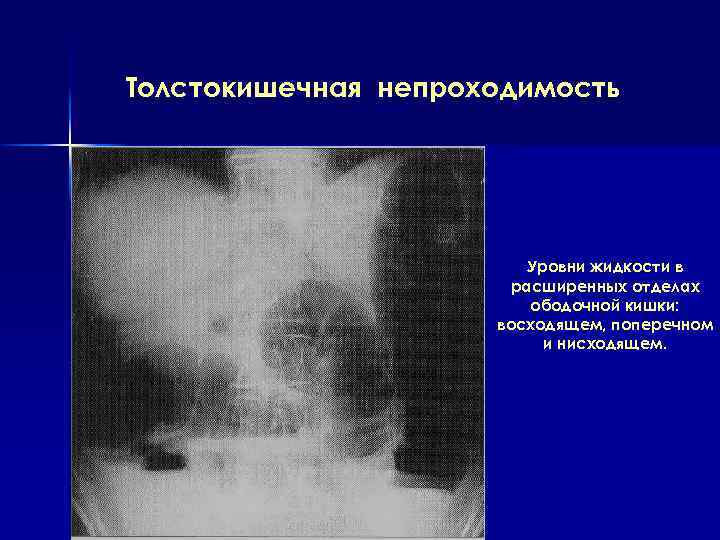 Кишечная непроходимость рентген