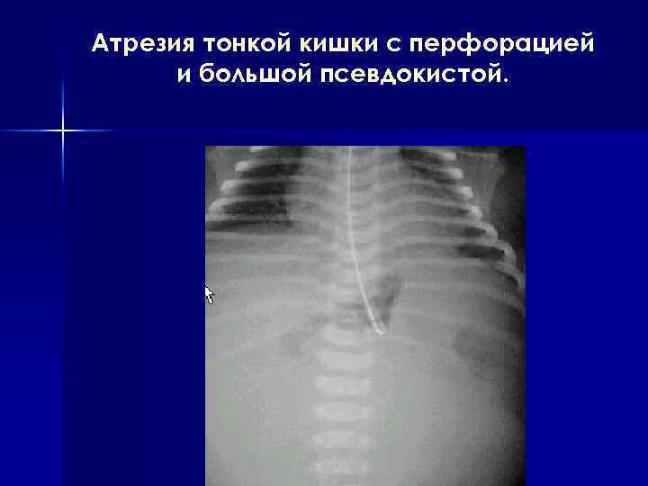 Атрезия тонкой кишки с перфорацией и большой псевдокистой. 