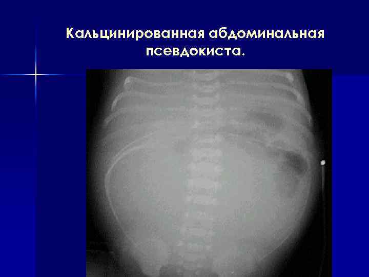 Кальцинированная абдоминальная псевдокиста. 