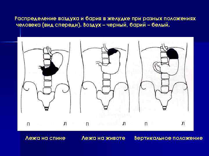 Распределение воздуха и бария в желудке при разных положениях человека (вид спереди). Воздух –