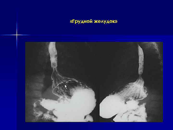  «Грудной желудок» 