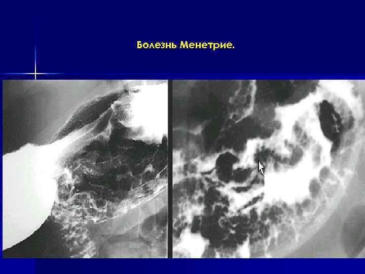 Болезнь Менетрие. 