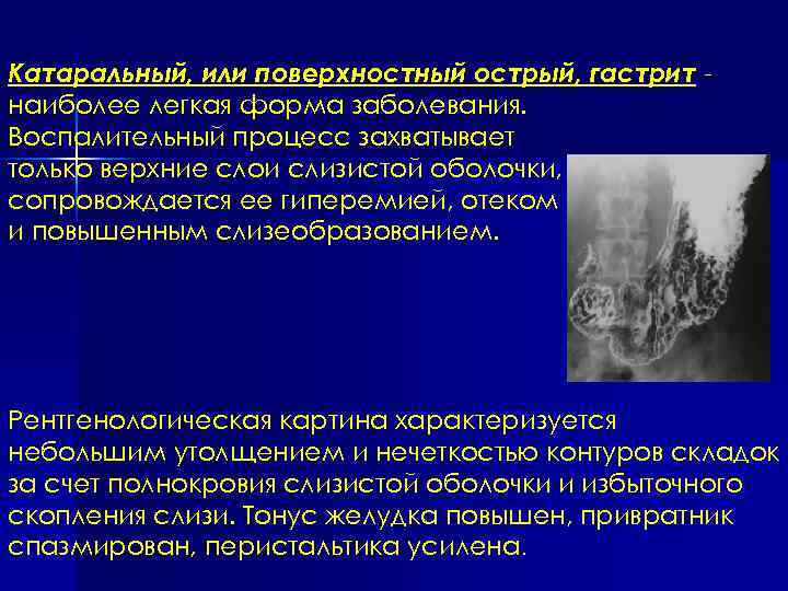 Катаральный, или поверхностный острый, гастрит наиболее легкая форма заболевания. Воспалительный процесс захватывает только верхние