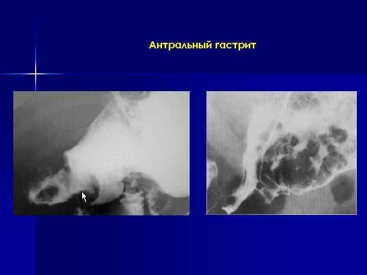 Антральный гастрит 