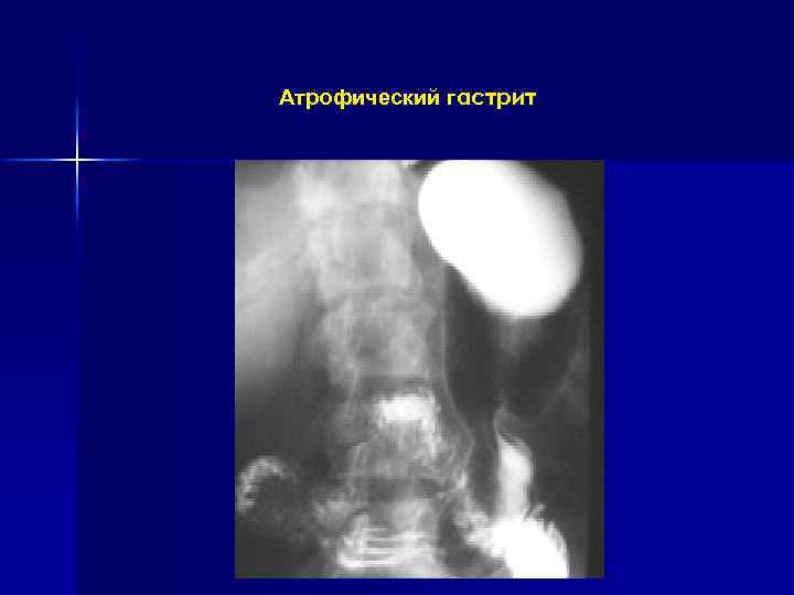 Атрофический гастрит 
