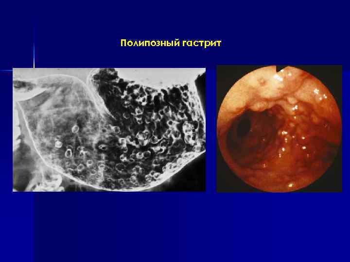 Полипозный гастрит 