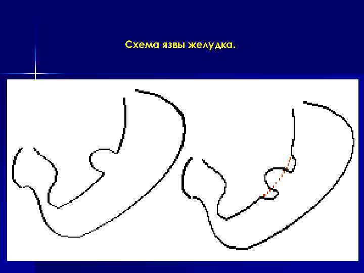 Схема язвы желудка. 